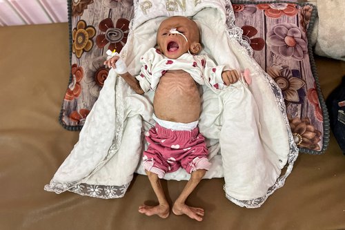 Palestinian girl diagnosed with malnutrition