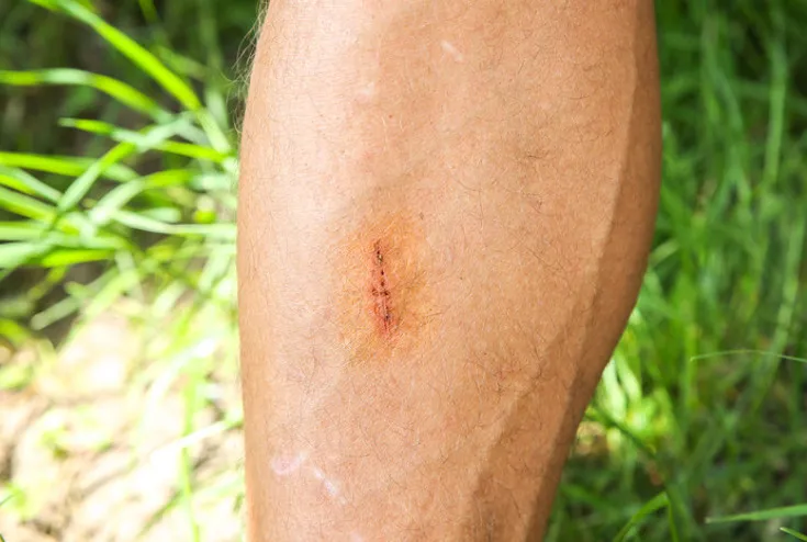 Korejski naučnici razvili sprej koji momentalno zaustavlja krvarenje