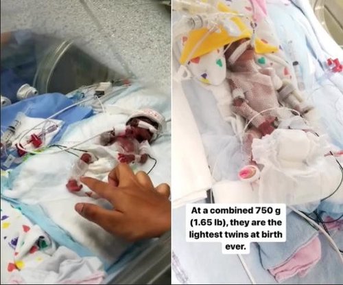 najmanji blizanci na svijetu