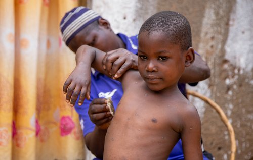 Mpox survivors return home after recovering in Kinama zone, in Bujumbura