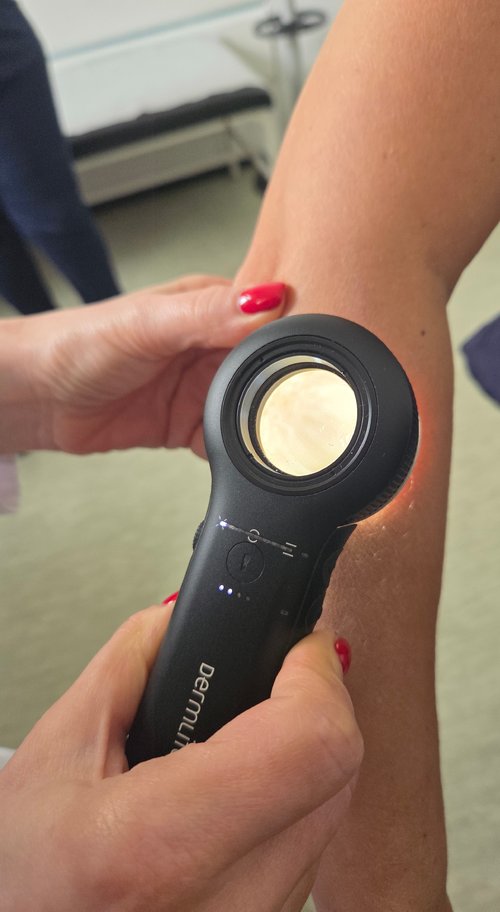 Pregled dermoskopom 1