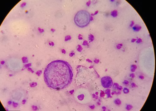 remzi huntov sindrom