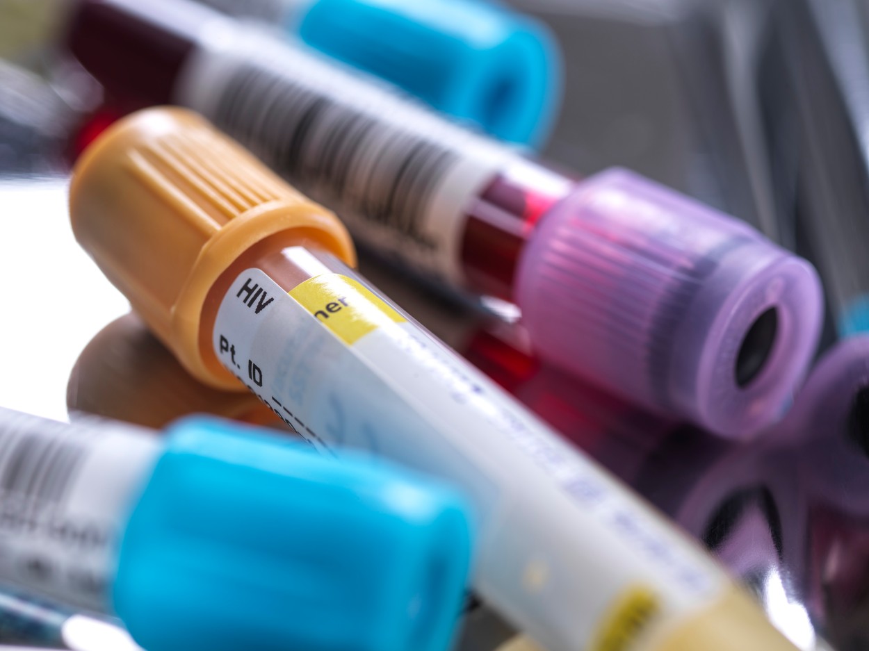 Sample for HIV testing