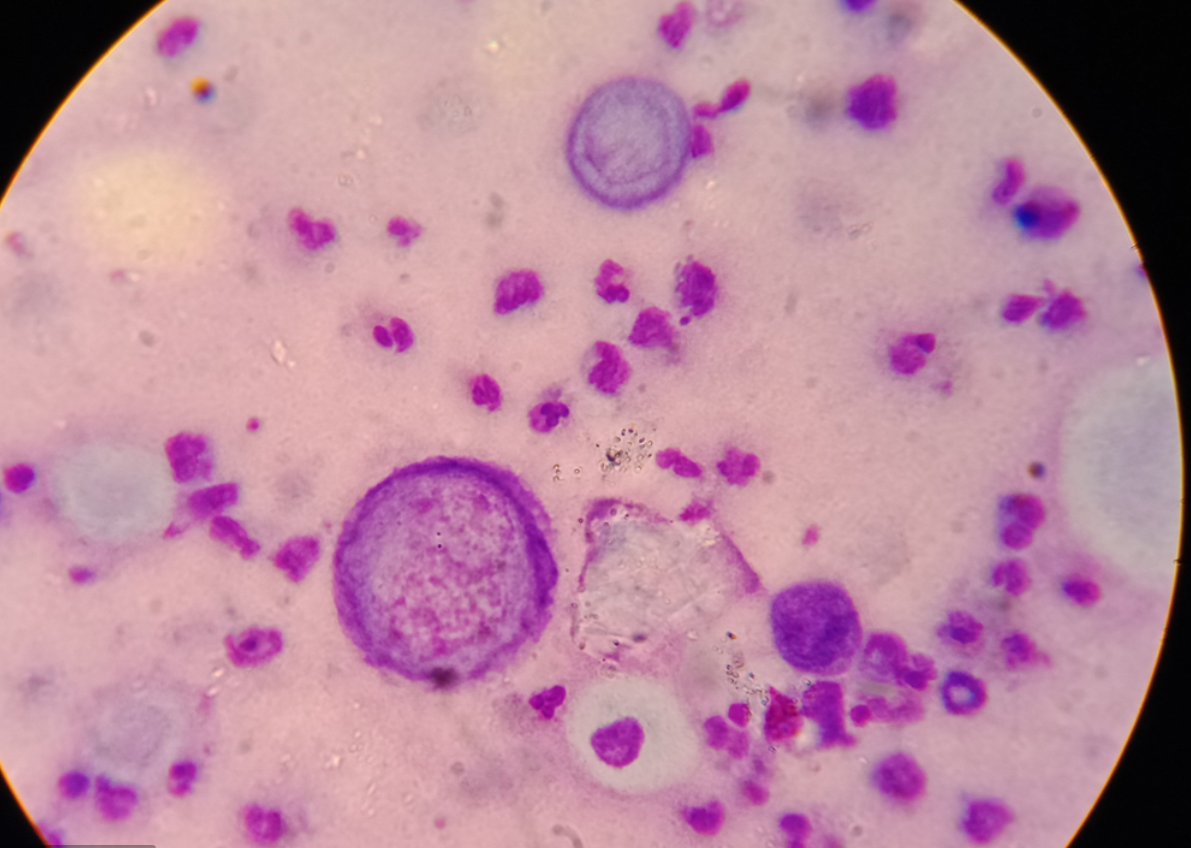 remzi huntov sindrom