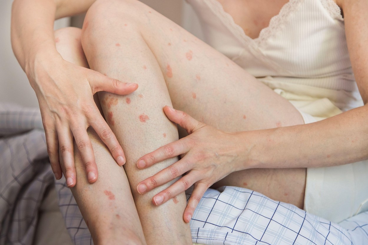 Close up of a person holding a leg.Body detail of Caucasian woman showing acceptance despite having skin problems.Concept of inclusion and self esteem
