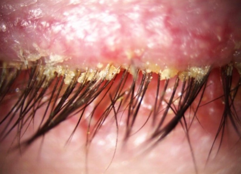 1704801349-demodex-Foto-Zajem-zaslona-FACEBOOK