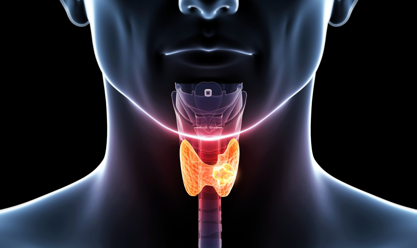 rak štitne žlijezde