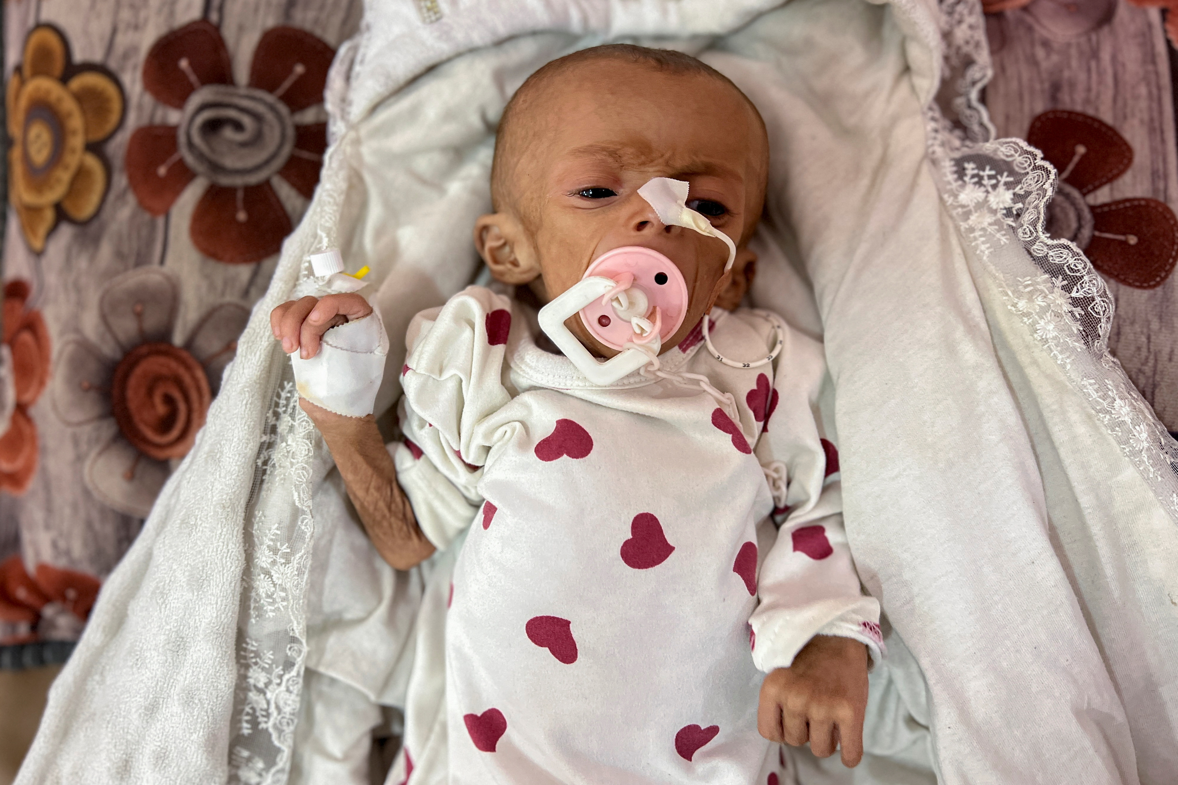 Zainab Abu Haleeb, a five-month-old Palestinian girl diagnosed with malnutrition, according to medics, receives treatment at Nasser hospital in Khan Younis, in the southern Gaza Strip