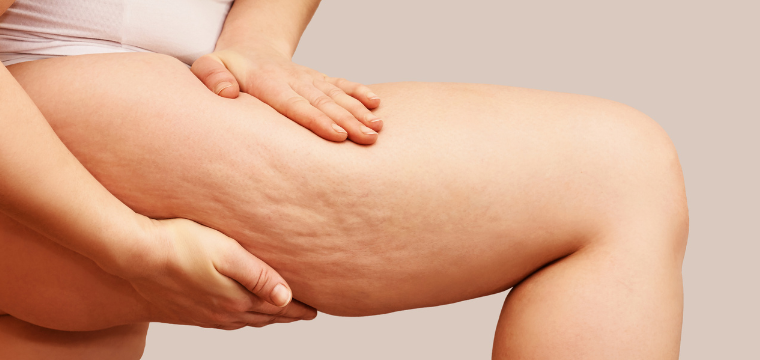 da li kreme za celulit zaista pomažU?