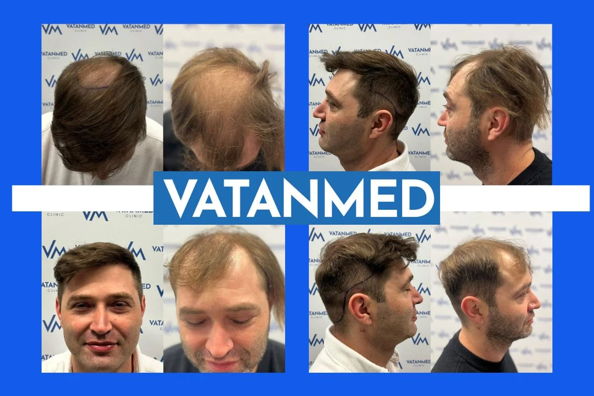 transplantacija kose primjer uspješnog zahvata kod muškarca klinika vatanmed bosna i hercegovina
